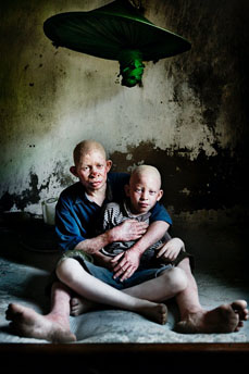 albini in africa